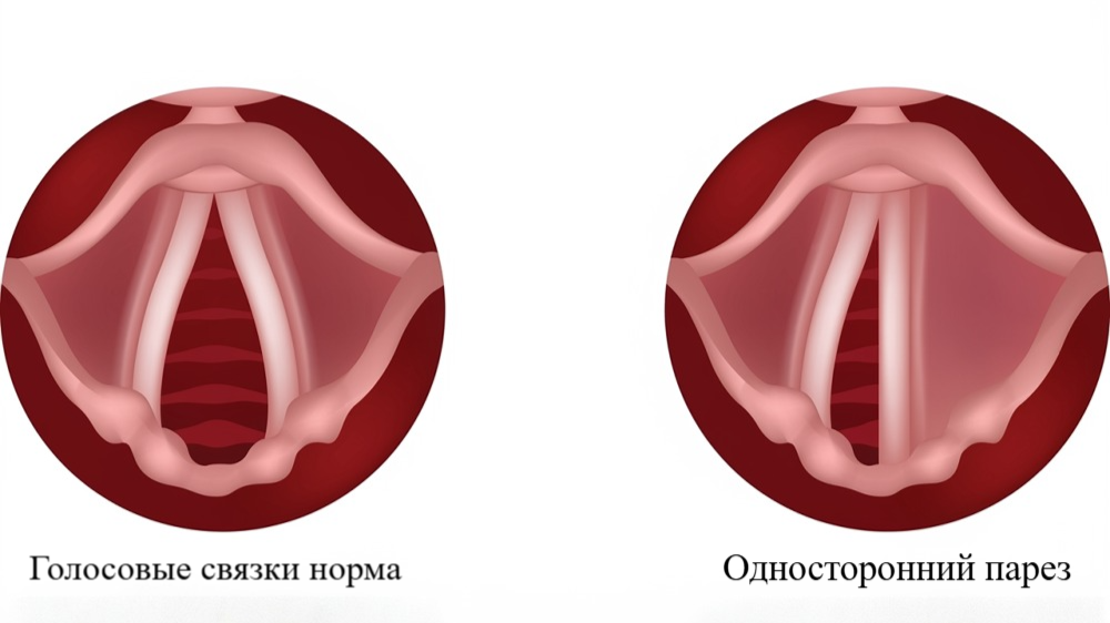 Парез гортани