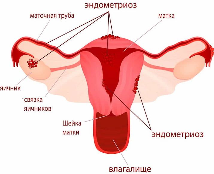 Хирургическое лечение эндометриоза