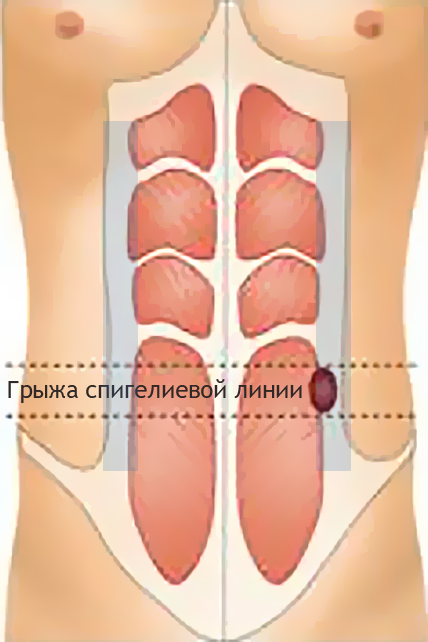 грыжа спигелиевой линии