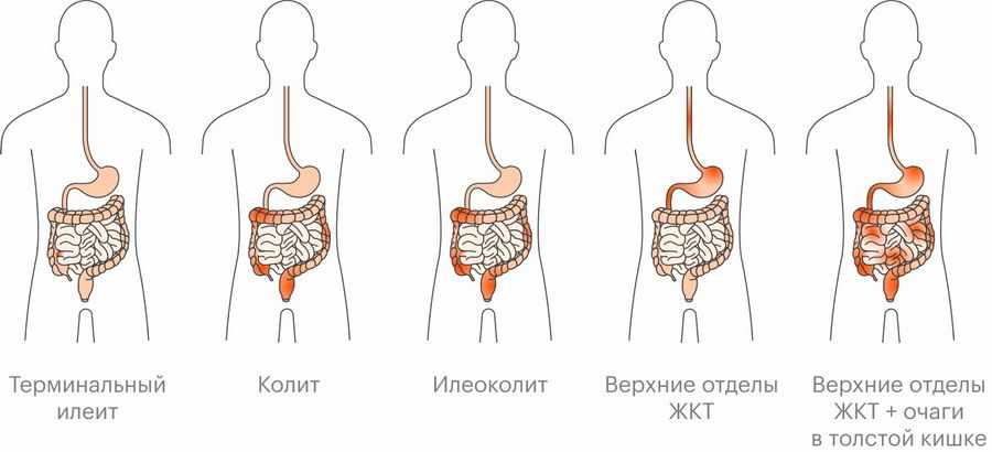 chto-takoe-bolezn-krona-i-skolko-stoit-ee-lechit-01.jpg