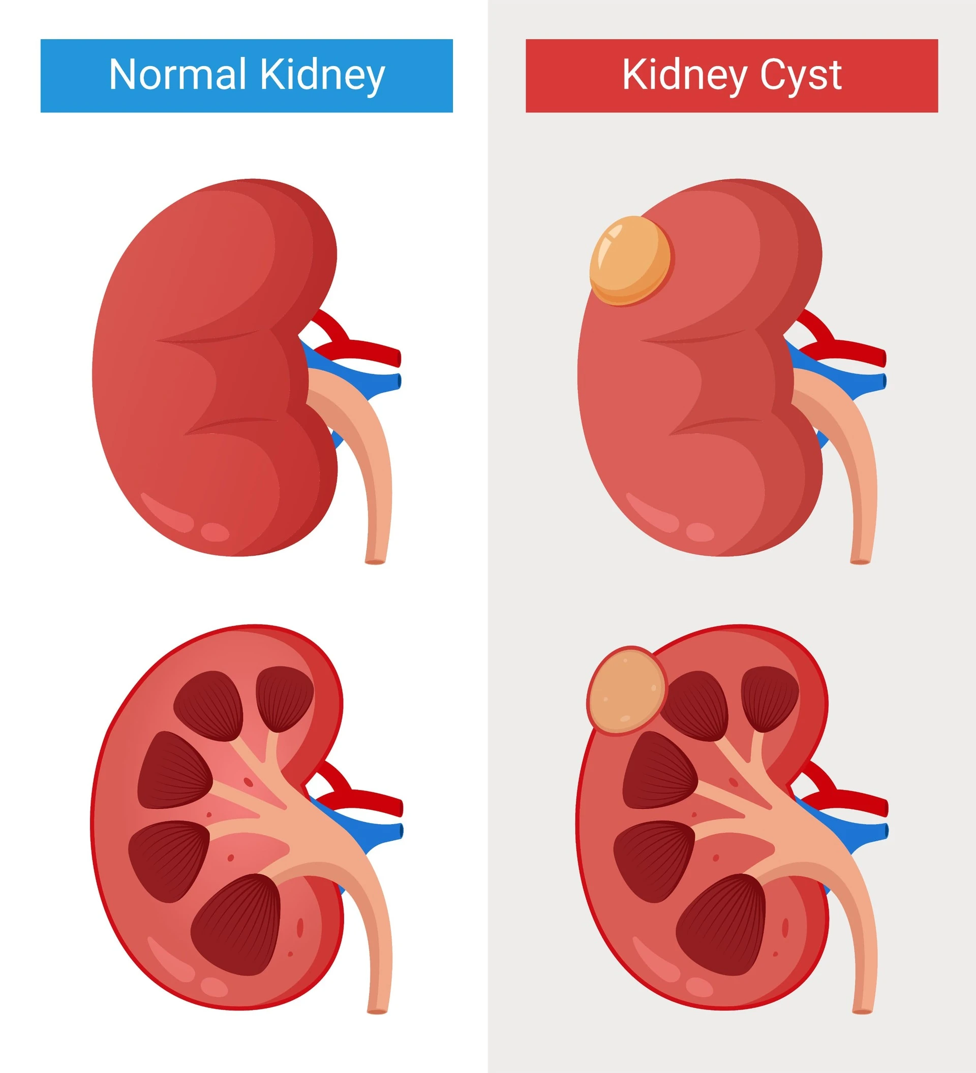 Кисты почек