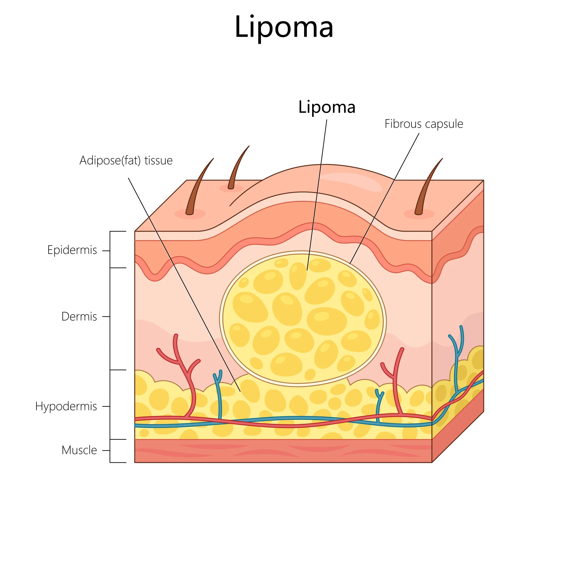 Удаление липомы