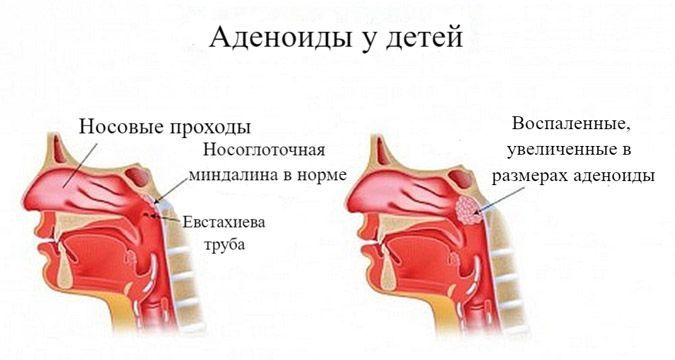 Удаление аденоидов у детей