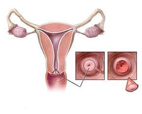 Конизация шейки матки