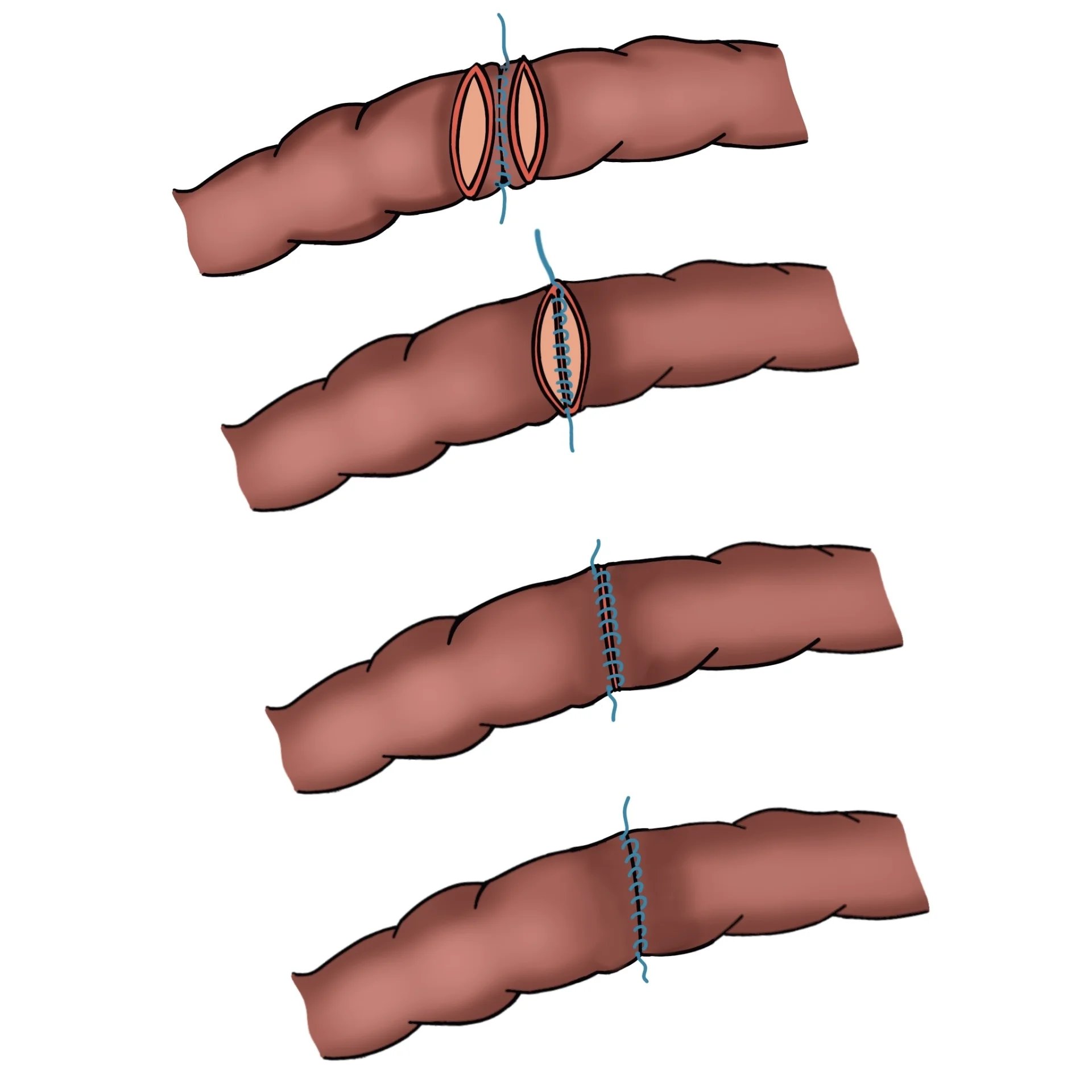Резекция тонкой кишки