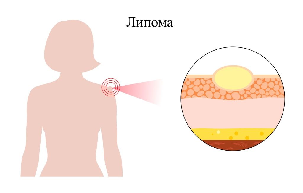 Липома