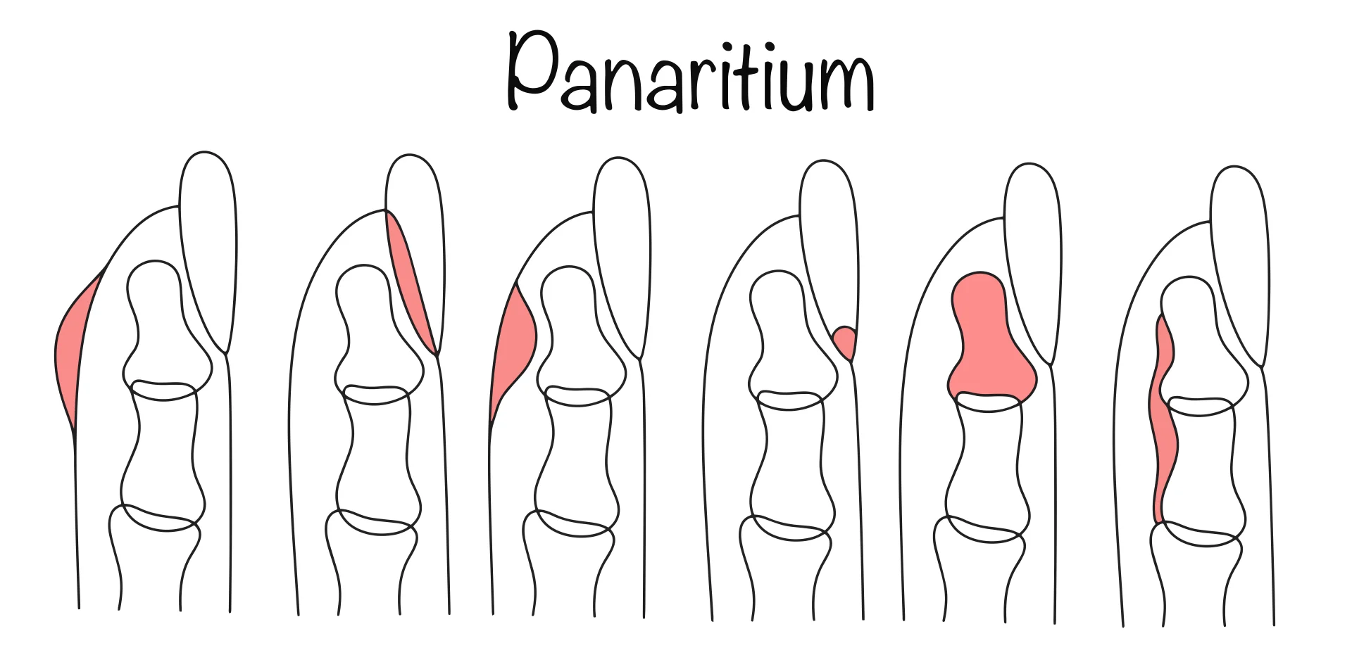 Вскрытие панариция