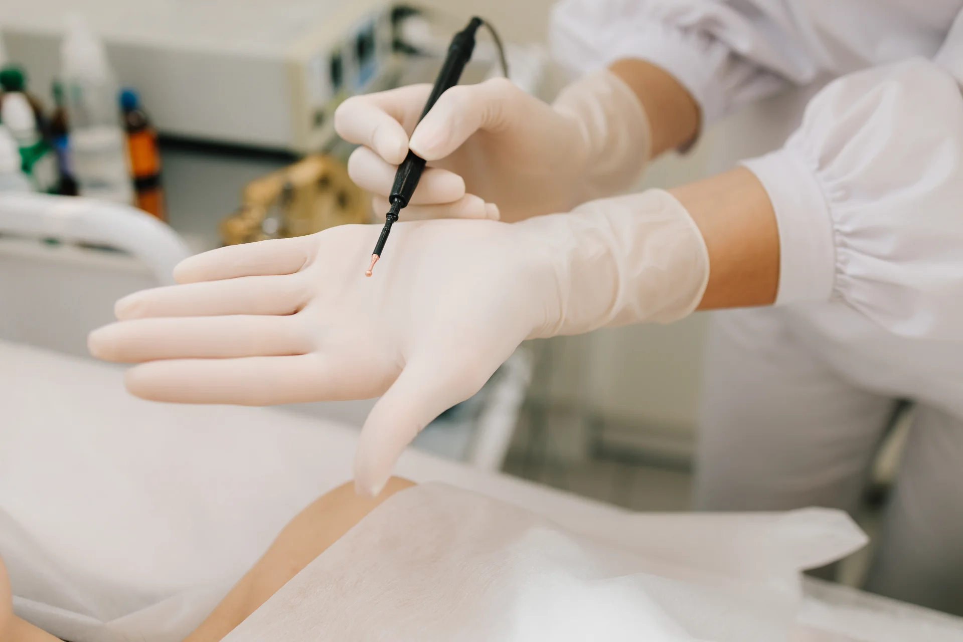 Удаление перианальных кондилом