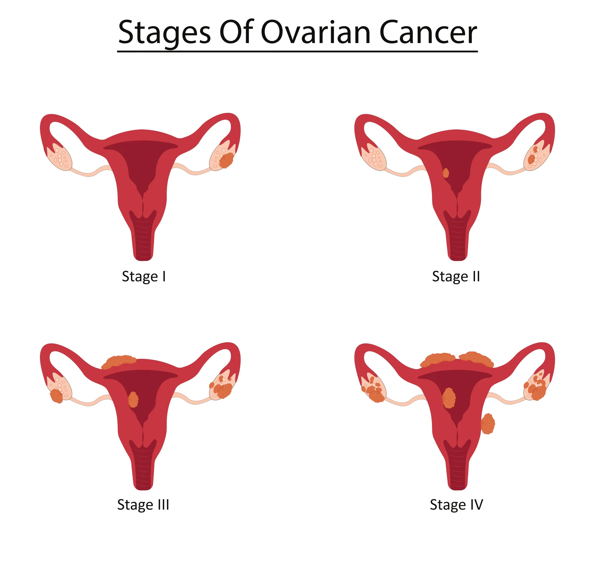 Рак яичников