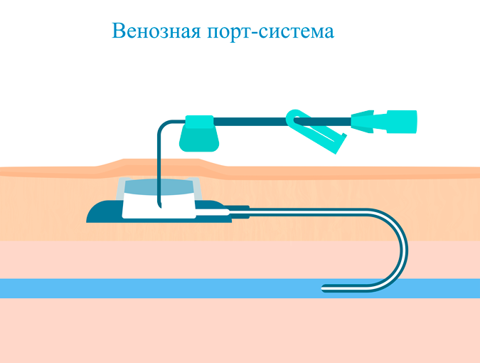 Установка порт-системы для химиотерапии