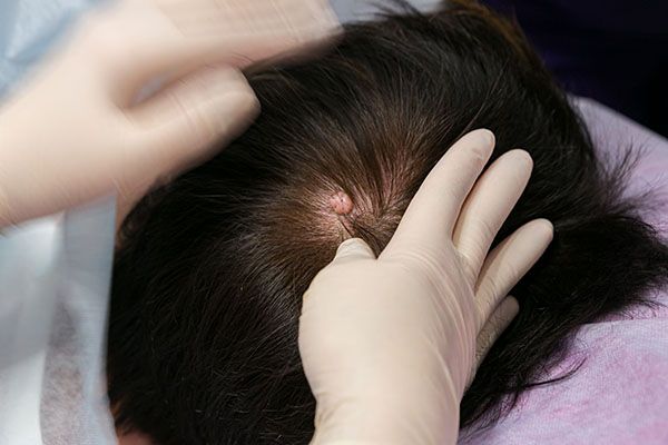Что такое жировик и как от него избавиться