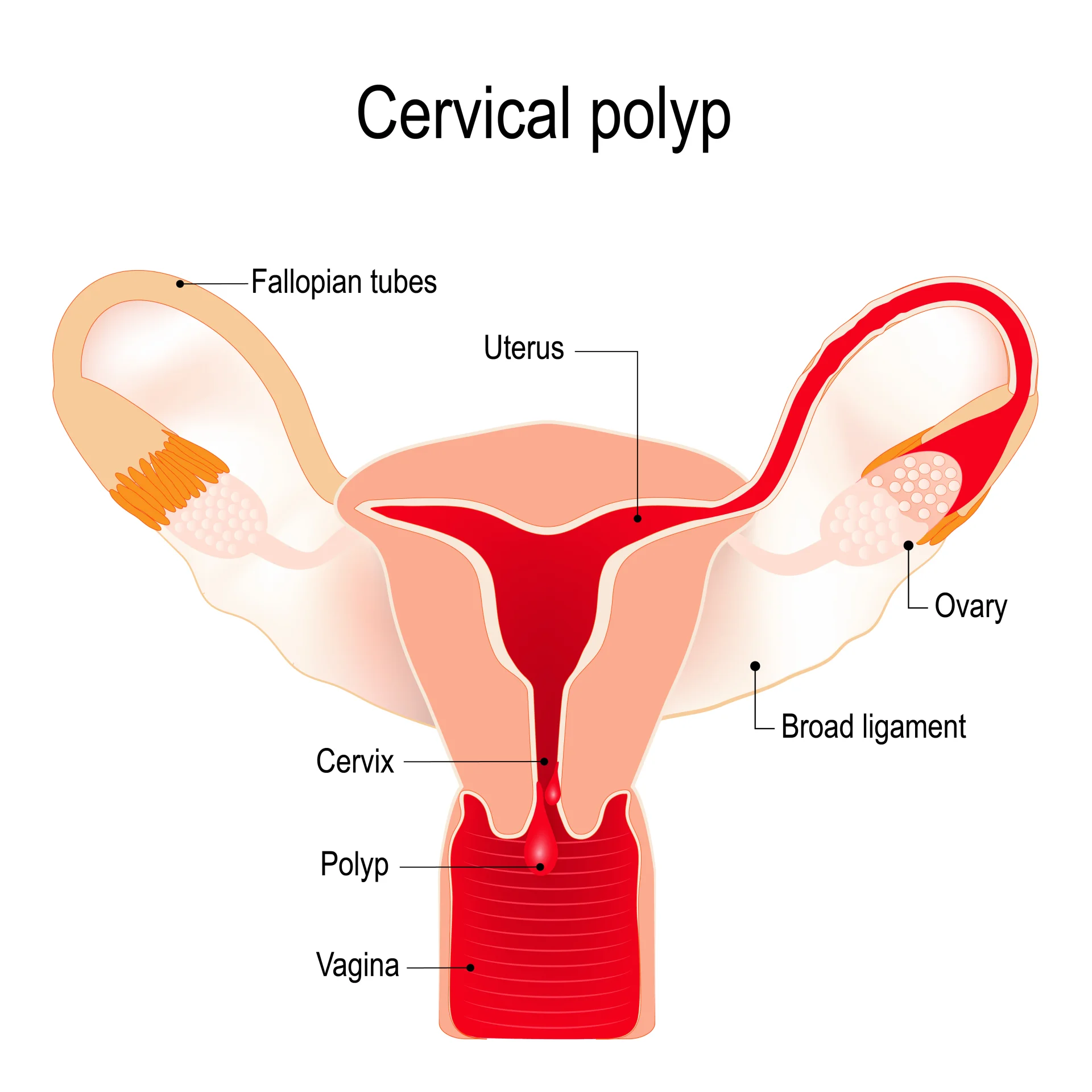 Удаление полипа цервикального канала