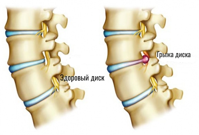 Операция по удалению межпозвоночной грыжи