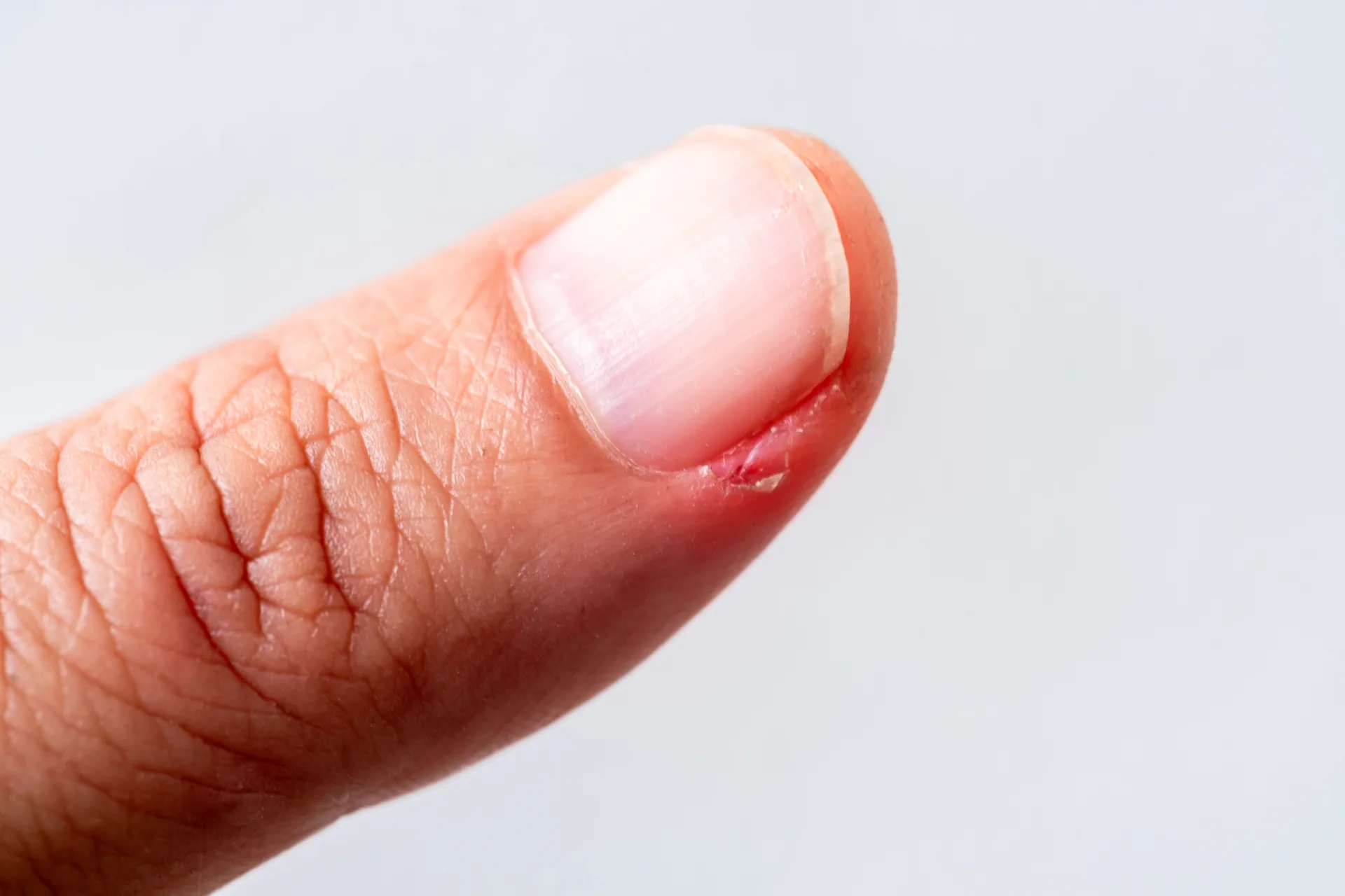 Вскрытие паронихия