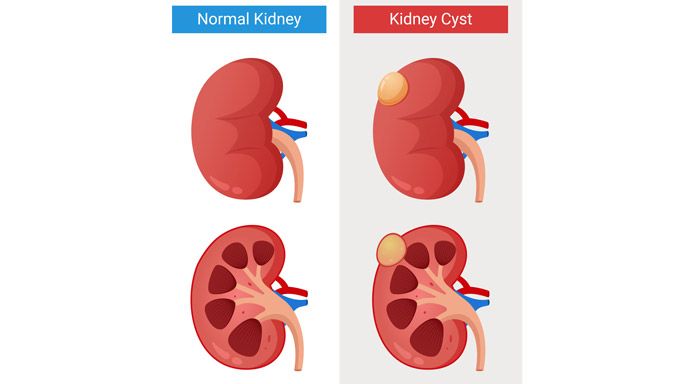 Кисты почек