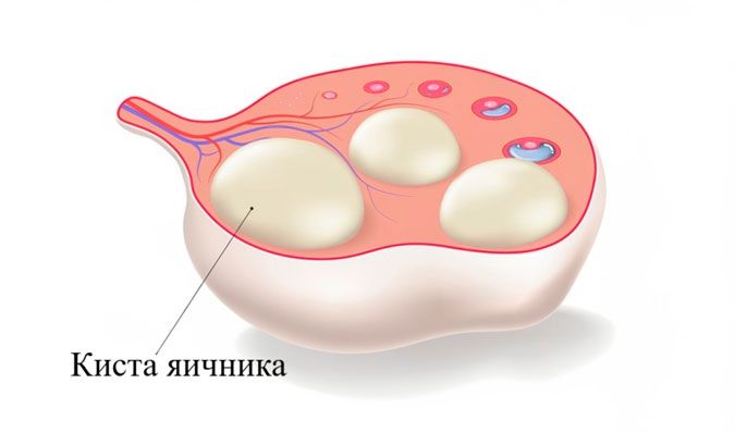 Киста яичника