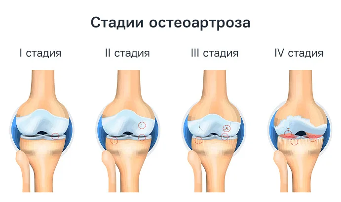 Диагностика остеоартроза