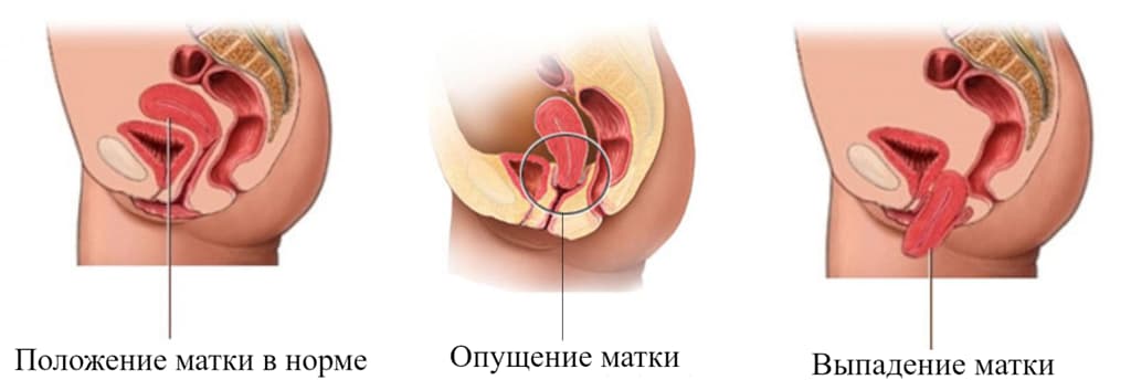 Операция при опущении и выпадении матки