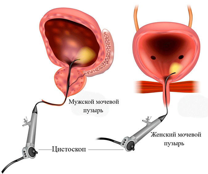 Цистоскопия