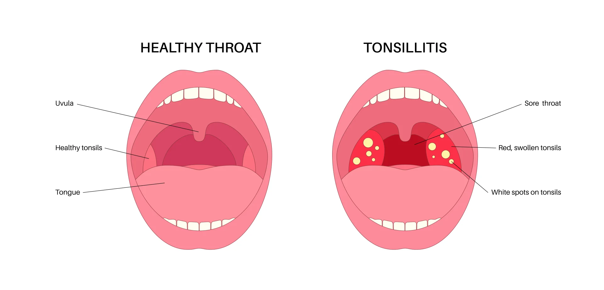 Тонзиллэктомия