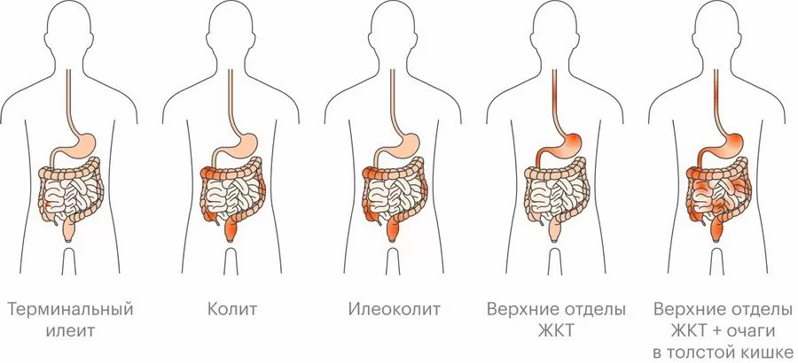 chto-takoe-bolezn-krona-i-skolko-stoit-ee-lechit-01.jpg